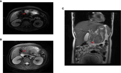 Effective control of postoperative recurrence of pregnancy-related gastric cancer using anti-PD-1 as a monotherapy: a case report